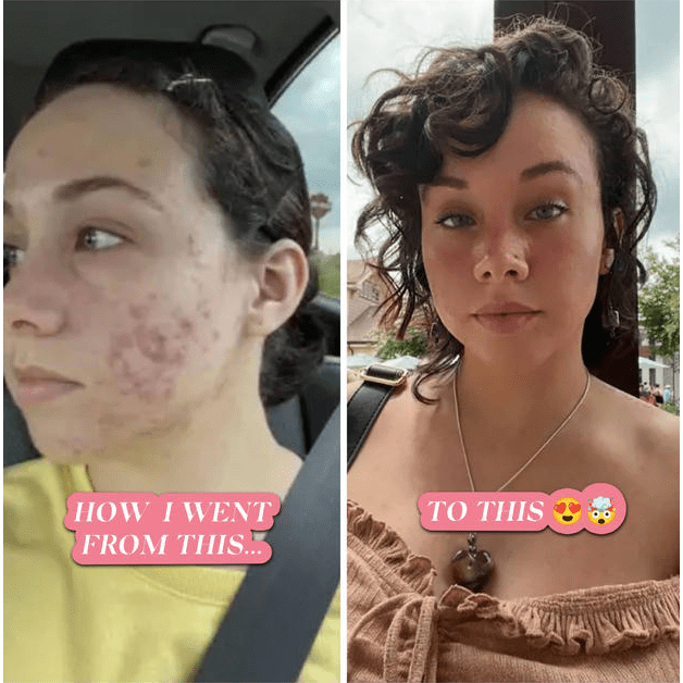 BalanC Toner - Bright Clear Skin | Pregnancy-safe Acne Toner
