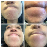 Pregnancy-safe Blemish Treatment Kit