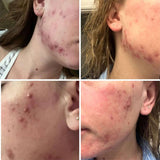 Pregnancy-safe Blemish Treatment Kit